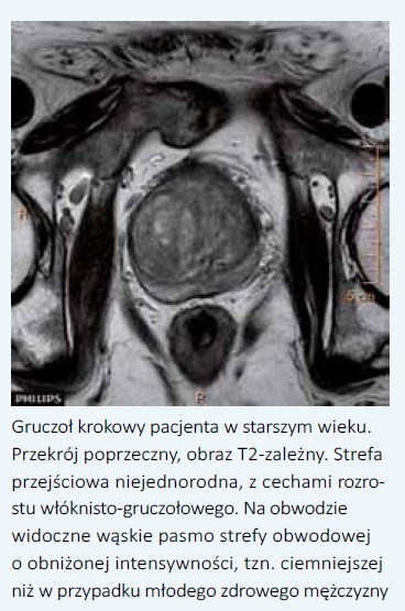 Amikor a prosztatitis van szaga